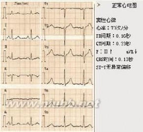 房室传导阻滞：房室传导阻滞-病理病因，房室传导阻滞-主要分类_完全性房室传导阻滞