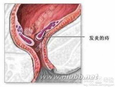 痔疮饮食 痔疮病人应该怎样注意饮食