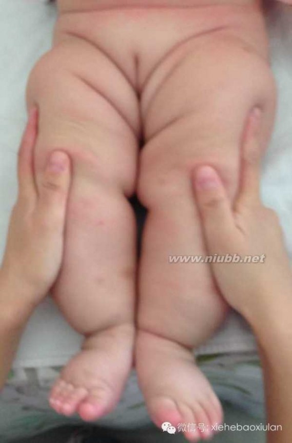 不对称 婴儿腿纹不对称，爸爸妈妈别着急！
