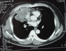 胸腺癌 胸腺癌的诊断和治疗