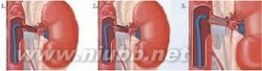 血管支架：血管支架-概述，血管支架-发展现状_心血管支架