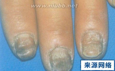 治疗灰指甲的小窍门 中医治疗灰指甲两大偏方