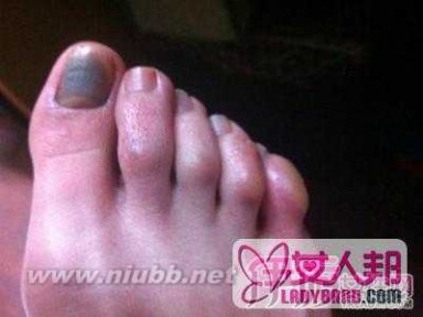 脚指甲变黑 脚指甲变黑的原因和治疗偏方 脚指甲变黑是灰指甲吗
