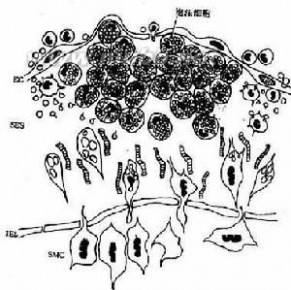 动脉粥样硬化：动脉粥样硬化-概述，动脉粥样硬化-介绍_动脉粥样硬化斑块