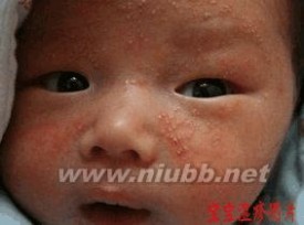 宝宝湿疹图片 宝宝湿疹照片