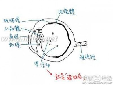 飞蚊症能治好吗 飞蚊症能彻底治愈吗？
