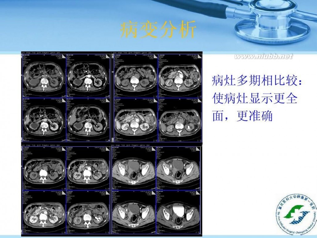 ctu 全尿路CTU重建