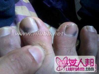 脚指甲变黑 脚指甲变黑的原因和治疗偏方 脚指甲变黑是灰指甲吗