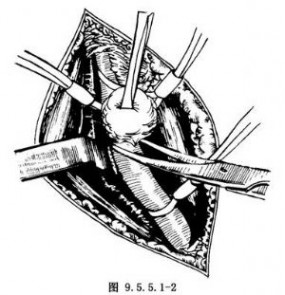 颈动脉瘤 颈动脉体瘤摘除术
