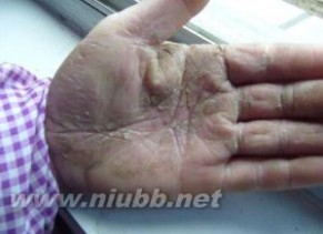 手裂：手裂-发病原因，手裂-发病季节_手裂