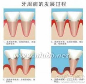 牙龈瘘管 牙周炎牙龈瘘管如何治疗